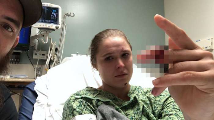 ronda-rousey-finger-accident-photo.jpg